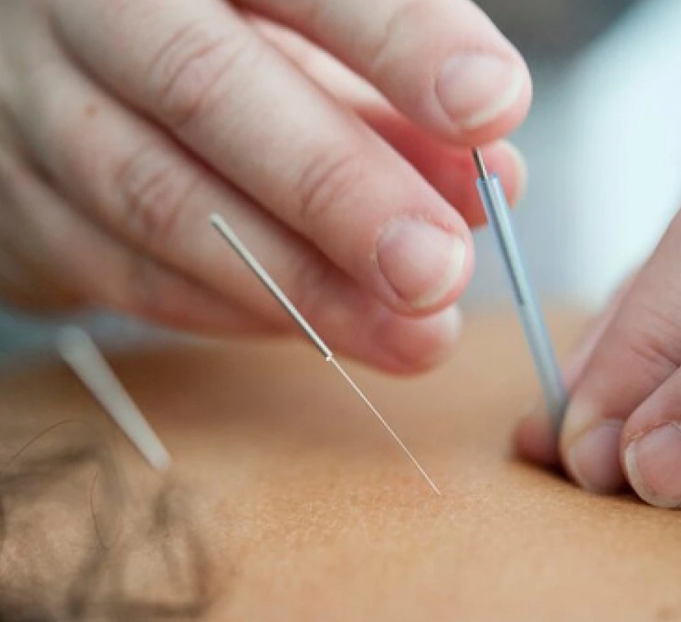 Dry Needling